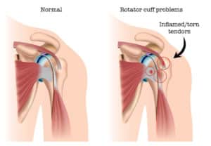 rotator cuff area