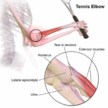 Tennis Elbow Therapy & Treatment