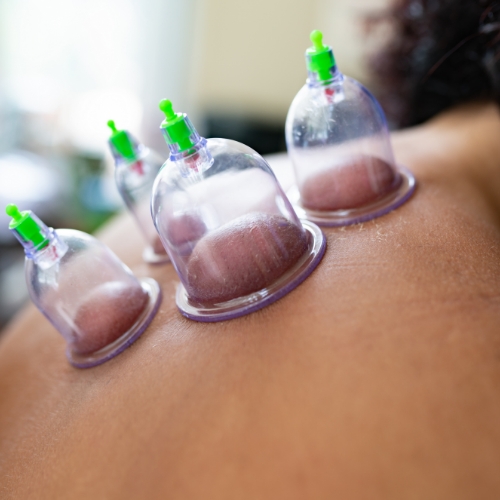 cupping-Advanced-Kinetics-Falls-Church-McLean-VA