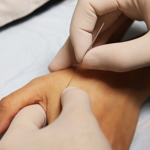dry-needling-Advanced-Kinetics-Falls-Church-McLean-VA